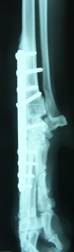 This picture shows a carpus 4 months after surgery to fuse the joint