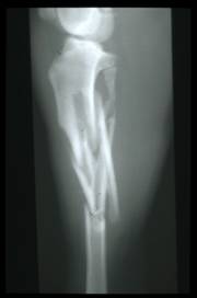 Fractures affecting Long Bones