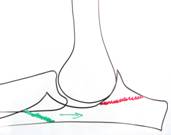 Green line indicates where Ulna is cut which allows movement to improve the way the joint fits together