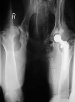 Hip after total joint replacement