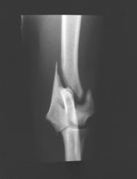 Fractures affecting Joints
